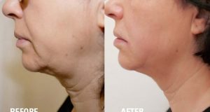 HIFU for Face Slimming 