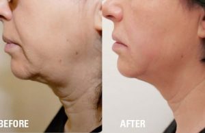 HIFU for Face Slimming 