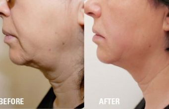 HIFU for Face Slimming 