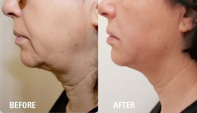 HIFU for Face Slimming 